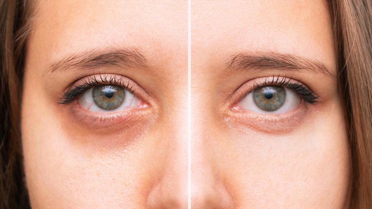 Dark Circles